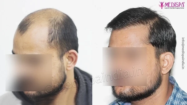 Best Ways To Find The Top Hair Transplant Surgeon in Udaipur