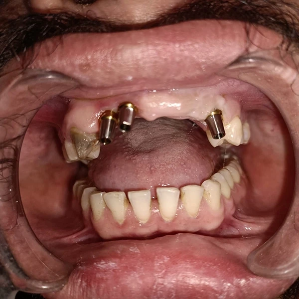 What are the top dentists and dental implants in Kolkata?