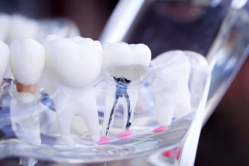 Sedation dentistry in Colorado Springs: relax and smile