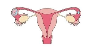 Are Ectopic Pregnancies More Common with IVF?