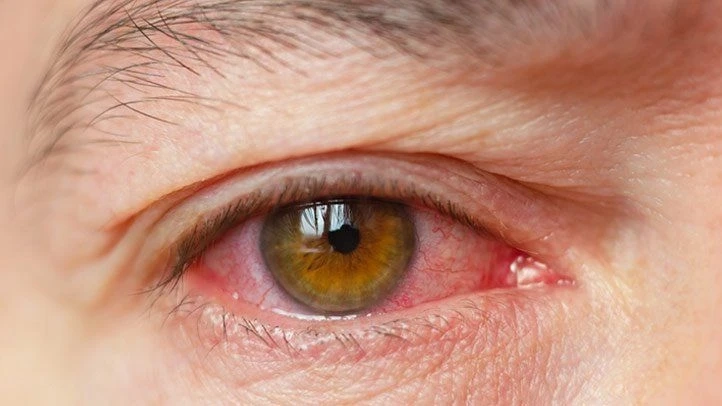 Dry Eye Disease Market to See Booming Growth 2023-2028