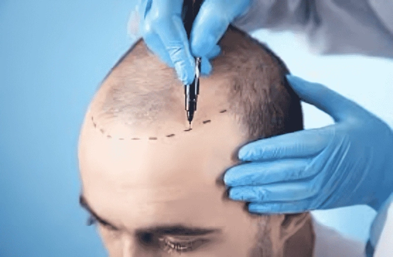 How to Choose the Best Hair Transplant Surgeon?