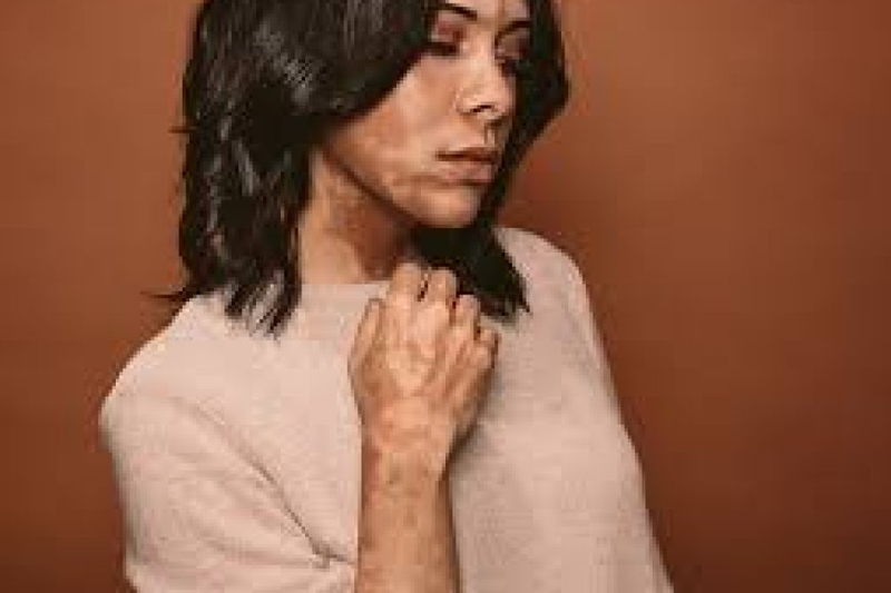 Finding the Best Vitiligo Dermatologist in Mumbai: Your Path to Effective Treatment