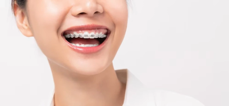 Perfecting Smiles: The Expertise of an Orthodontist