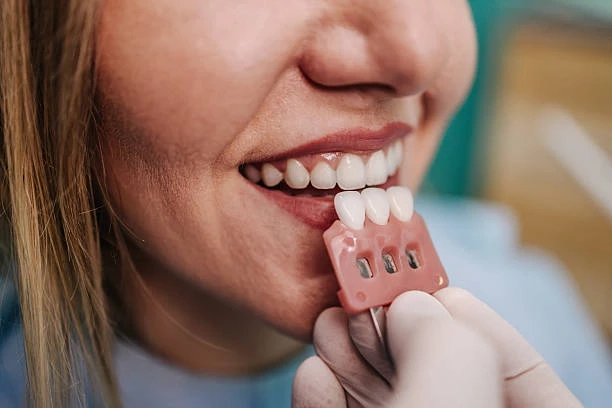 Everything You Should Know About Porcelain Veneers Before Getting Them