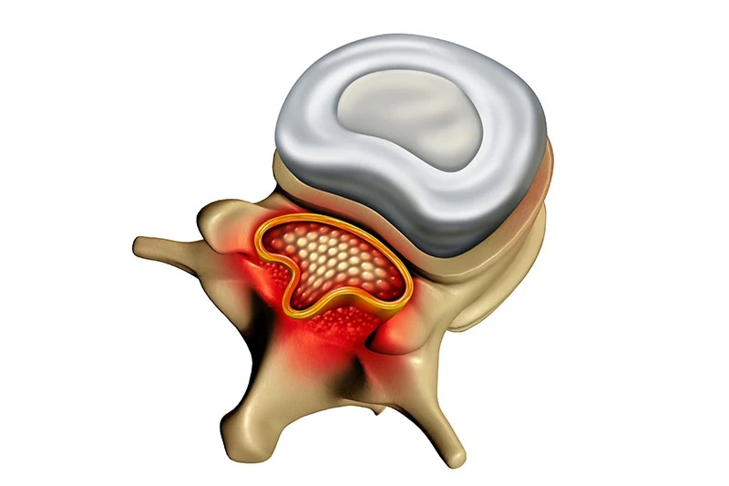 X-RAYS MAY ASSIST WITH THE DIAGNOSIS AND TREATMENT FOR BACK PAIN RELIEF