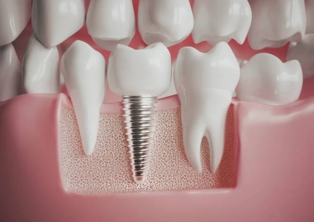 The Benefits of Choosing a Top-Rated Implant Dentist for Your Treatment