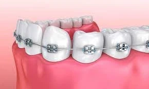 Beyond Aesthetics- How Dental Braces Help in Preventing Oral Health Issues