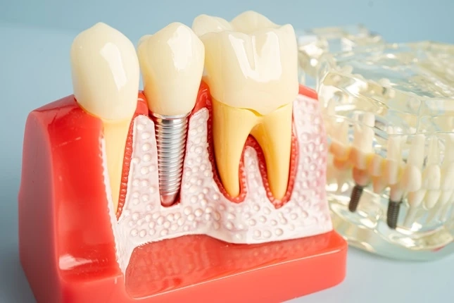 Your Aftercare Guide For Dental Implants