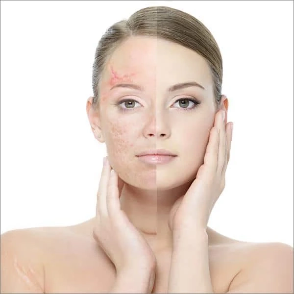 Laser Therapy for Acne Scars: The Role of Session Count in Your Treatment Plan