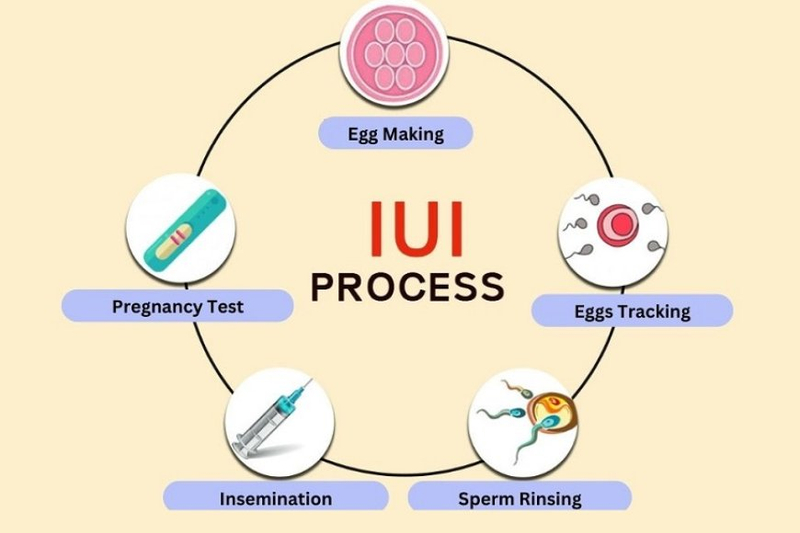 Understanding the Basics: What Is IUI Treatment and How Does It Work?