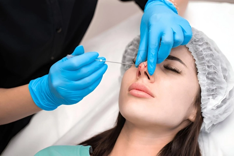 How Rhinoplasty Surgery Helps Correct Genetic Nose Shape Defect?