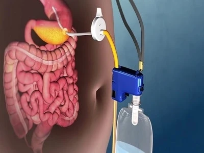 UAE Bariatric Surgical Devices Market to Grow with Impressive CAGR until 2027 | TechSci Research