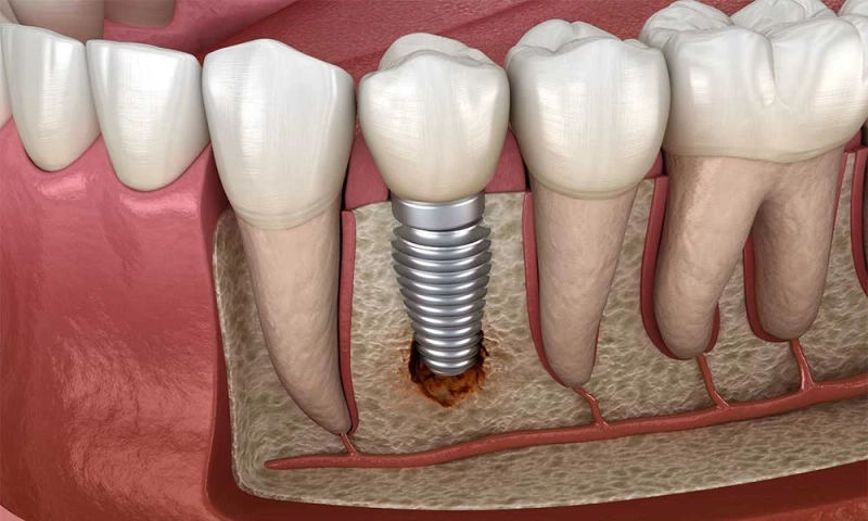 Single Tooth Implant - Choosing the Right Dental Practice