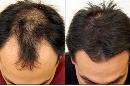 Is FUE Hair Transplant For Curly & Straight Hair Different?