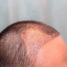 Everything You Need to Know about Sideburn Restoration & Hair Restoration