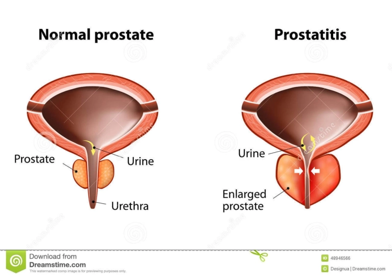 Akut prostatit tedavisi pdf