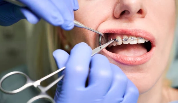 Smile Renewal: Finding an Ideal Orthodontist Near Me For Adults