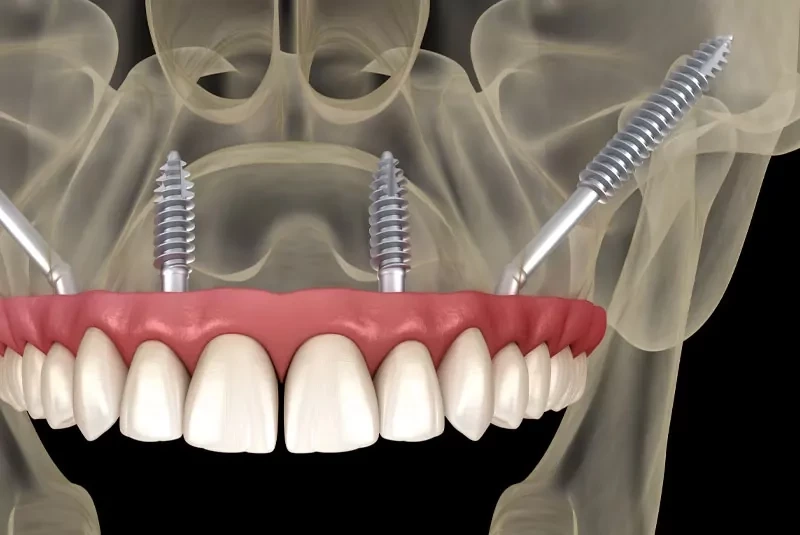 Advanced Zygomatic Dental Implants in Irvine