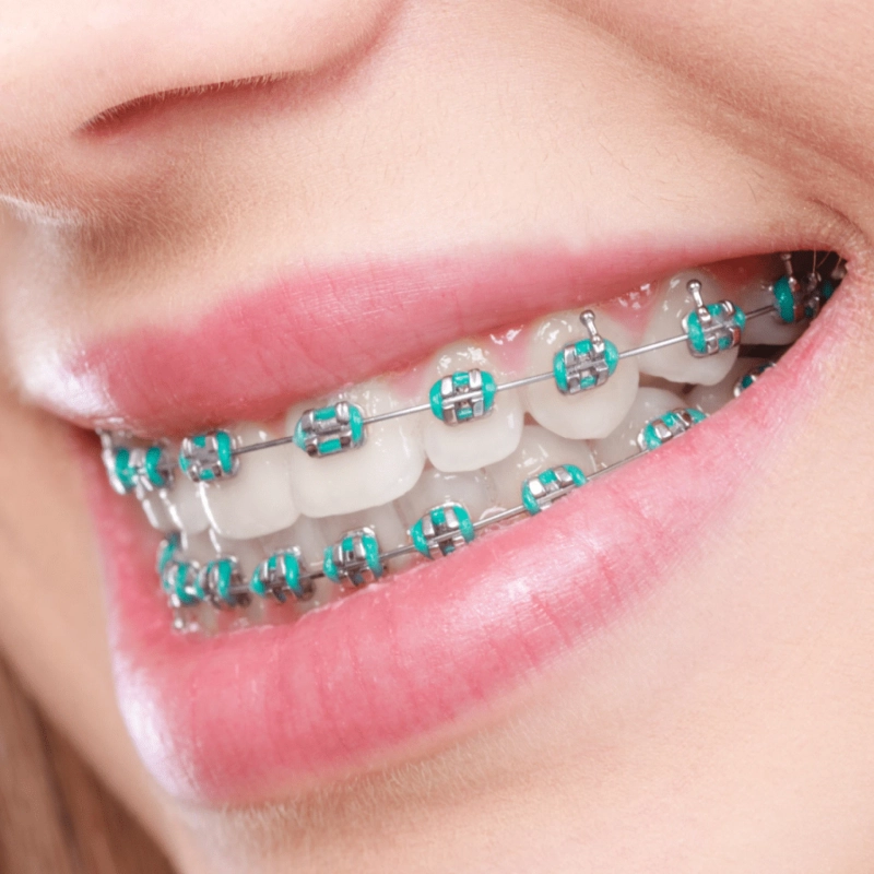 Dental Braces: Straighten Your Smile