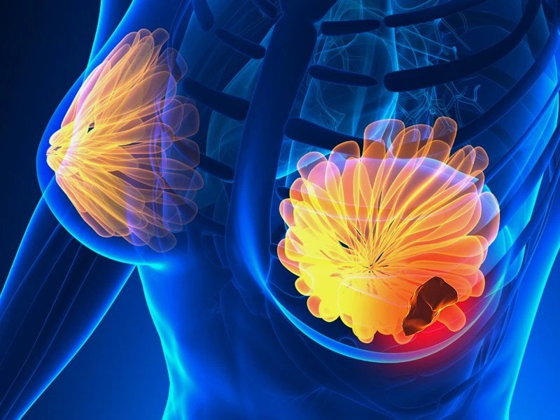 Breast Cancer Therapeutics; Depend On Several Factors, such as the Type and Stage of Cancer