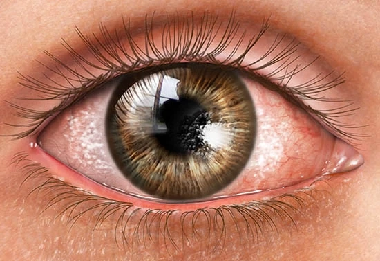 Dry Eye Syndrome Market Size, Share, Growth | Forecast Report 2024-32