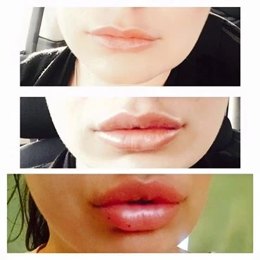 Things to Know About Lip Filler Treatments