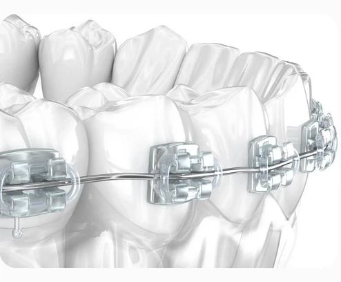 Transform Your Smile with Quality Orthodontic Care in Anaheim
