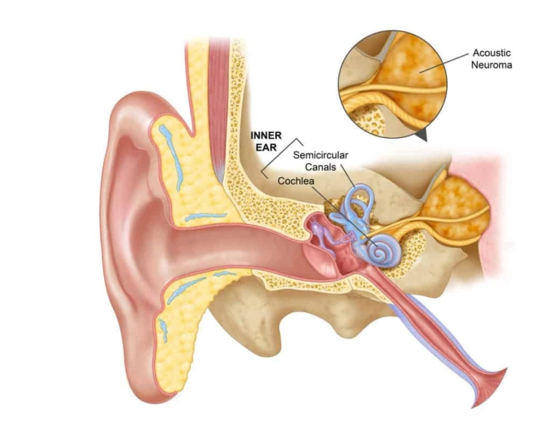 What is acoustic neuroma?