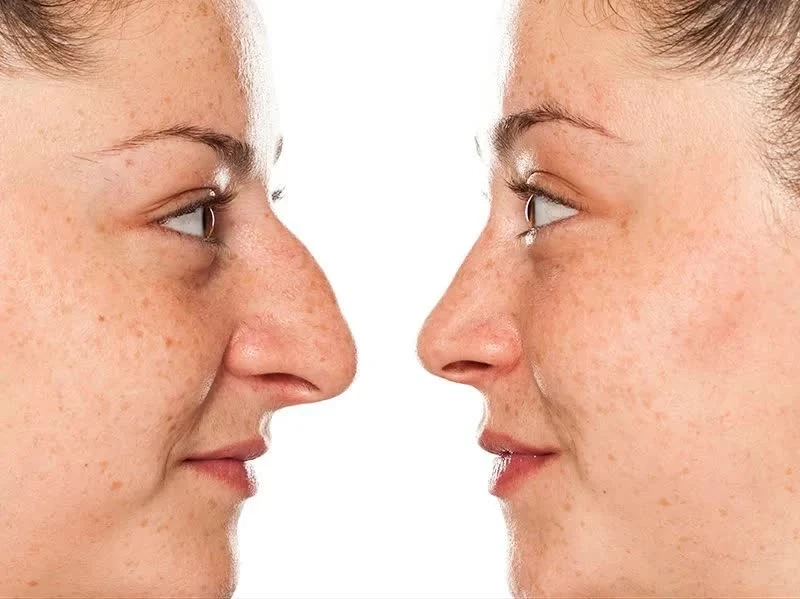 UNDERSTANDING ABOUT NOSE SURGERY IN COLOMBIA