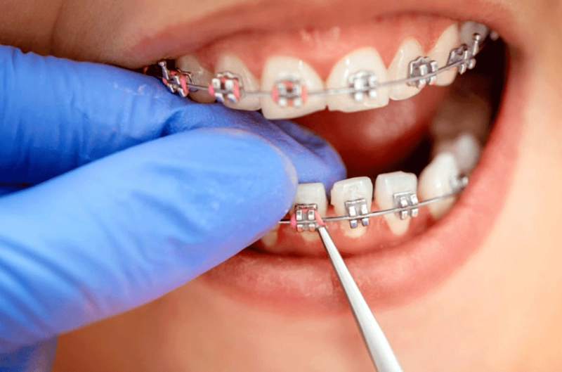 Ceramic Braces in London: A Comprehensive Guide