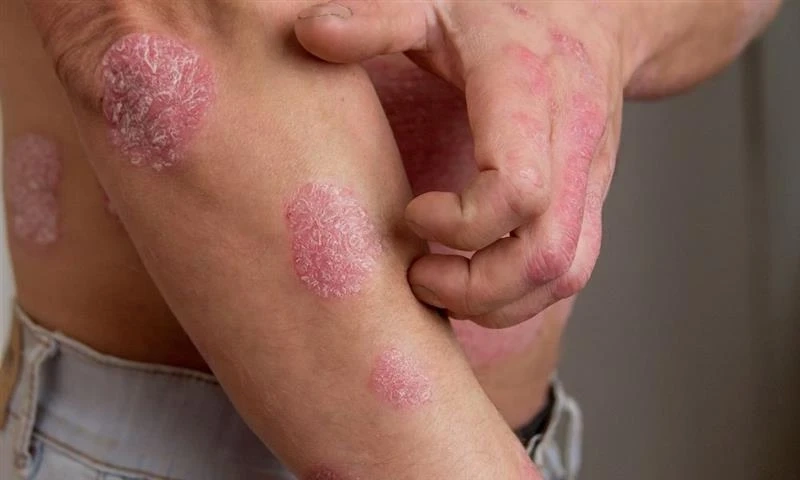 Top 10 Psoriasis Treatment Methods Recommended by Dermatologists