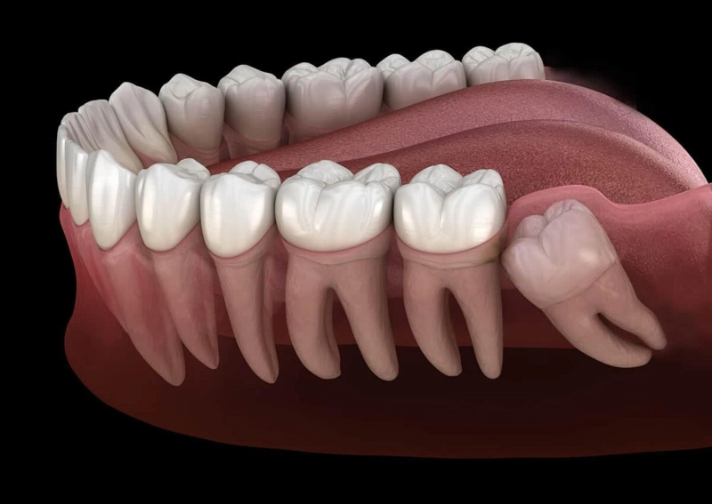 Everything You Should Know About Wisdom Teeth Extractions: A Patient's Handbook