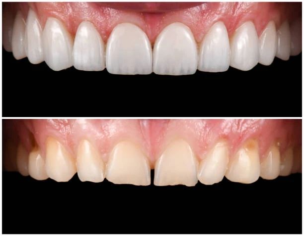 6 Subtle Ways Veneers Change More Than Just Your Smile