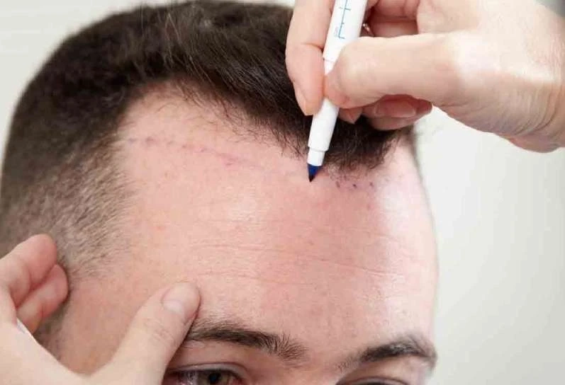 Can Dandruff & Dry Scalp Cancel Your Hair Transplant?