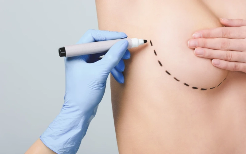 An Overview of Breast Lift Techniques in Combination with Augmentation
