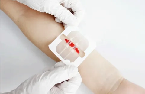 Non-invasive Surgical Wound Closure Market key findings from recent clinical trials and published journals