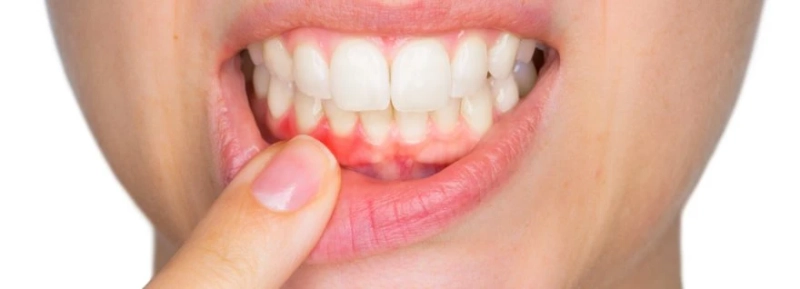 What Is Gum Disease? Everything You Need To Know About Gum Disease