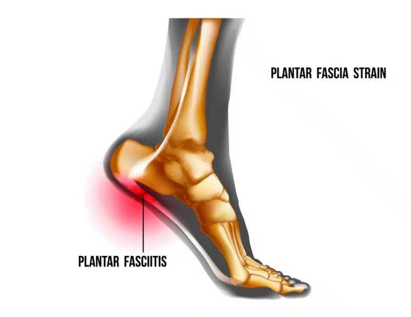 Relieving Plantar Heel Pain: How Massage and Exercise Work Together