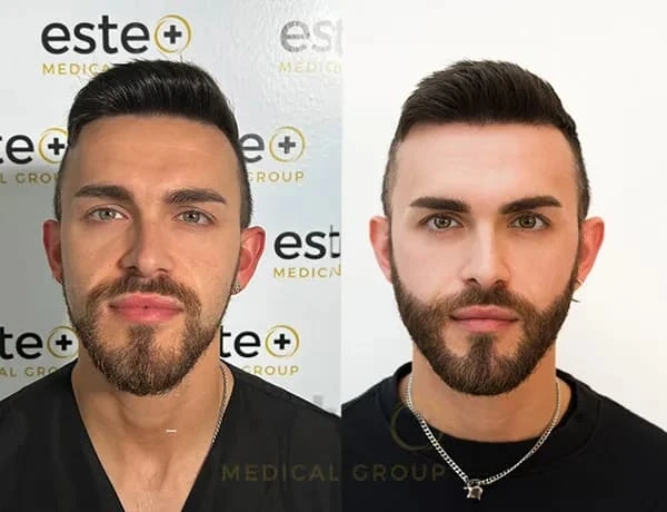 Procedure Day: What Happens During a Beard Hair Transplant