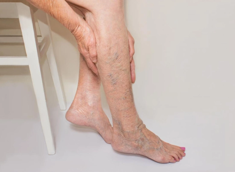 Varicose Veins Treatment Market, Get Market Research, Business Risk & Industry Analysis Reports 2027