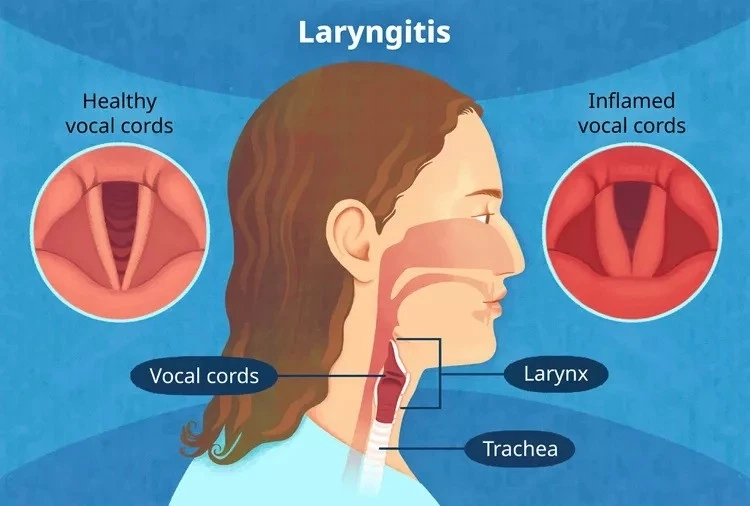 Laryngitis or Hoarseness of Voice: Causes, Diagnosis, Treatment, and Home Remedy