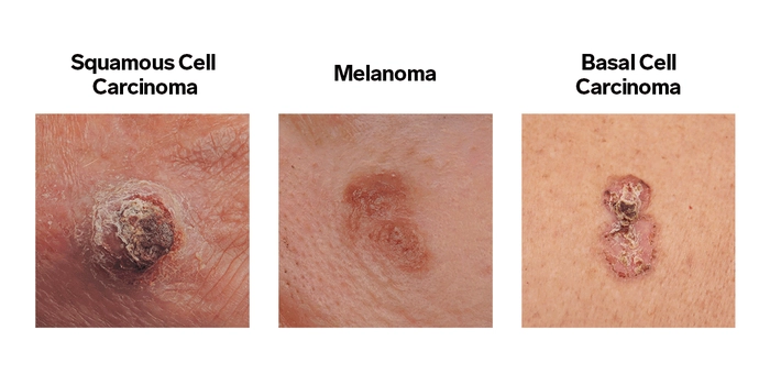 Melanoma vs. Other Skin Cancers: What's the Difference?