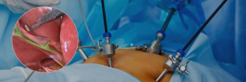 Expert Hepatobiliary Care: Meet the Best Laparoscopic Surgeons in Delhi
