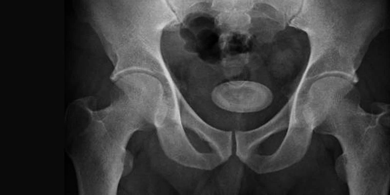 Insights on Bladder stones Causes and Treatment