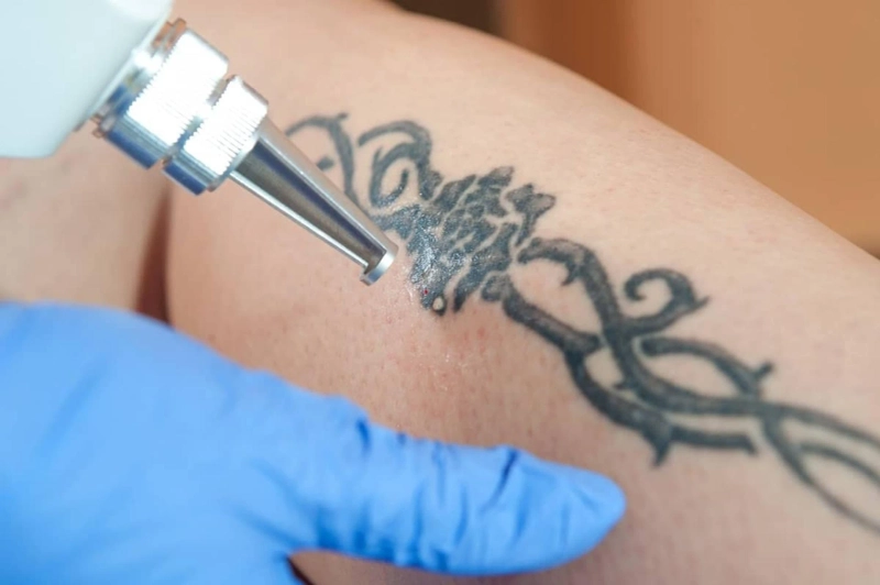 PicoSure Tattoo Removal in Dubai: A Laser Precision Solution