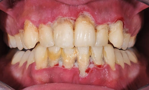 Achieve a Perfect Smile: Dental Bridges in Riyadh