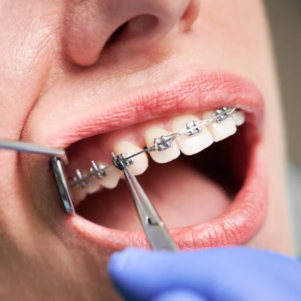 A Confident Smile Awaits with Expert New Canaan Braces Care