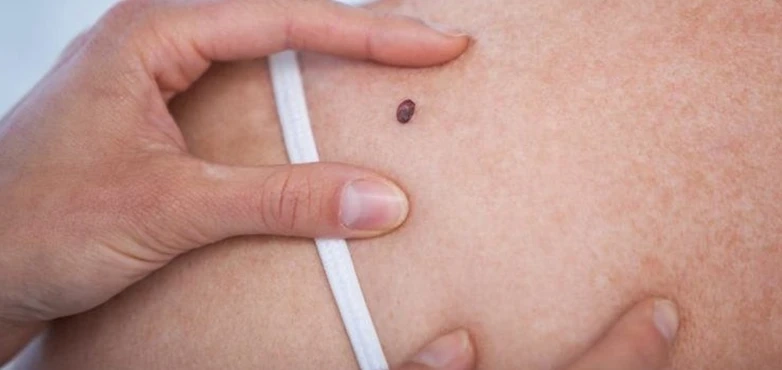 Types of Skin Cancer Diagnosed in Melbourne