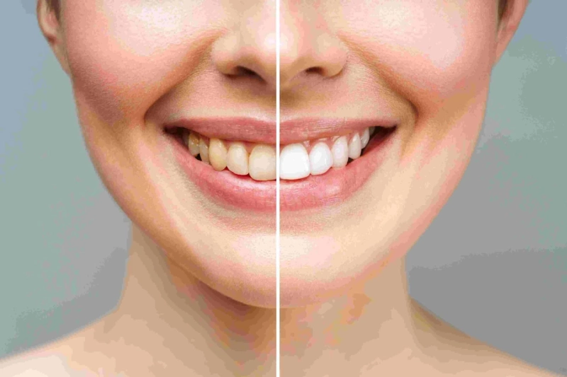 Advantages and disadvantages of Hollywood smile